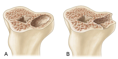 Valgus Knee (VII) Management Of Bone Defect