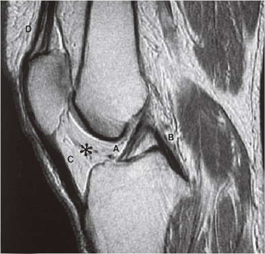 anatomy of the knee joint: cruciate ligament-Anterior Cruciate Ligament ACL