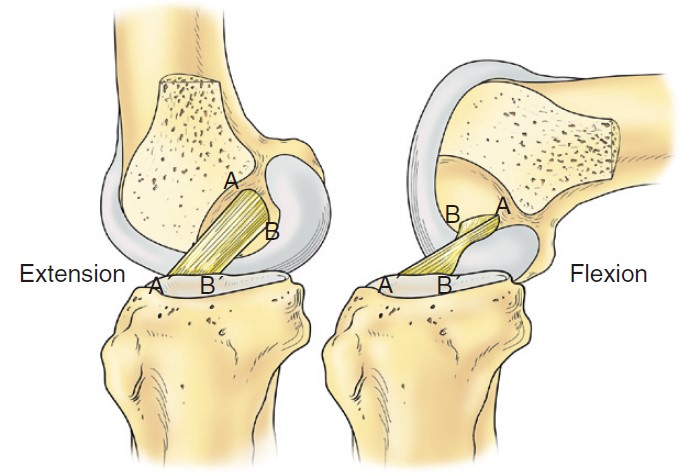 Knee Joint Prosthesis