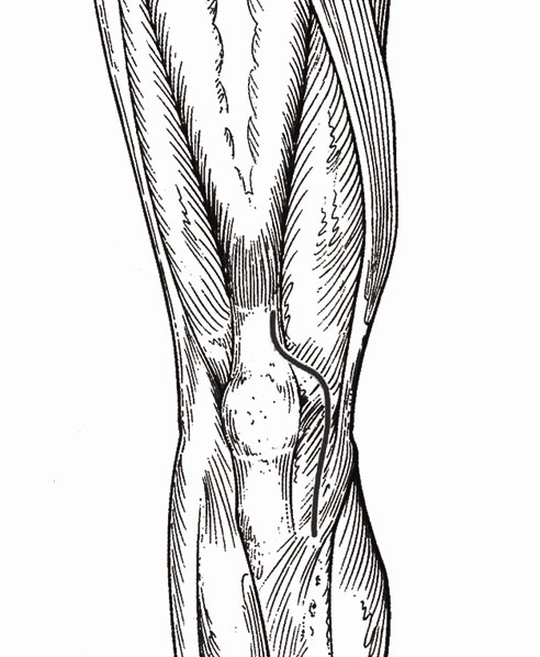 Primary Total Knee Arthroplasty Surgical Technique