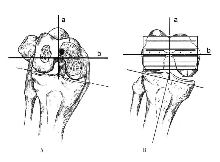 Valgus Knee(Ⅳ)Bone Preparation