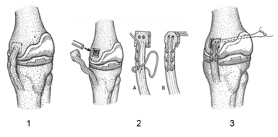 Valgus Knee(Ⅵ)Medial Ligament Advancement