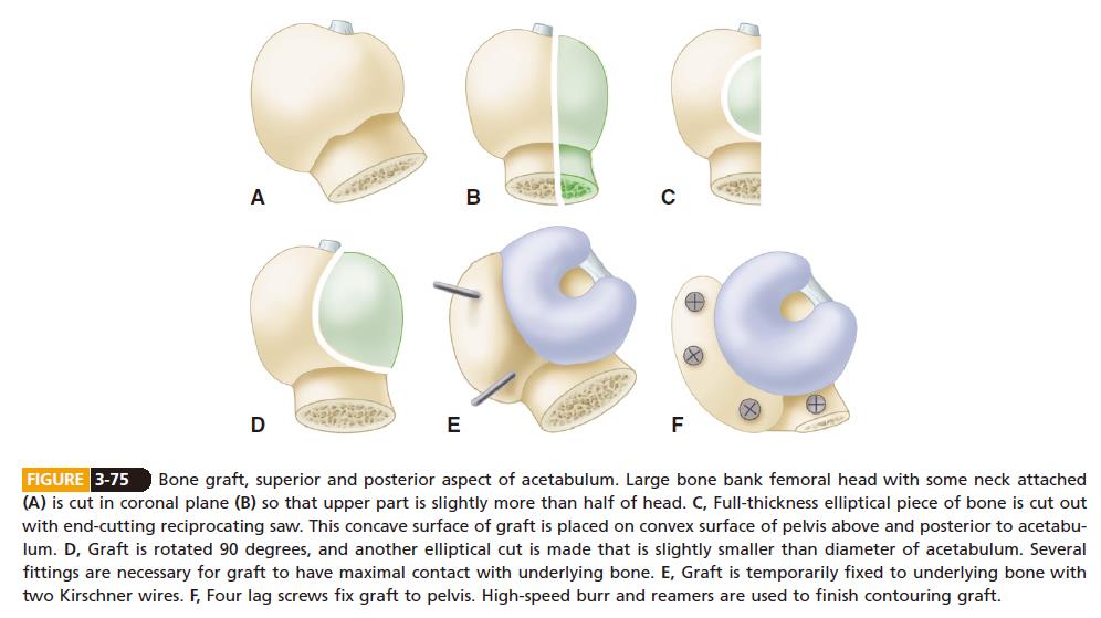 Surgery of DDH of acetabulum Ⅱ