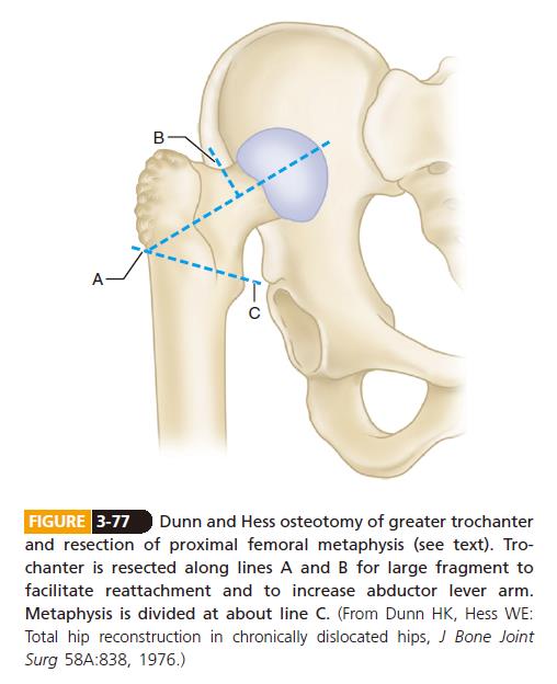 Surgery of DDH of femur