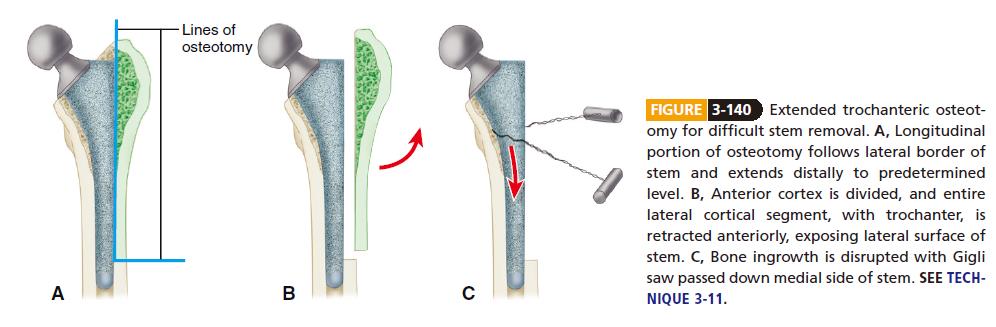 Removal of cemented femoral component