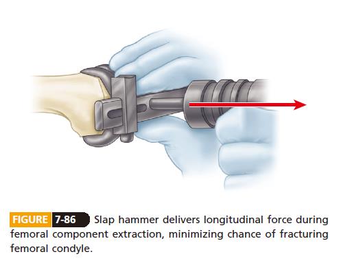 Revisión de artroplastia total de rodilla - extracción de componentes