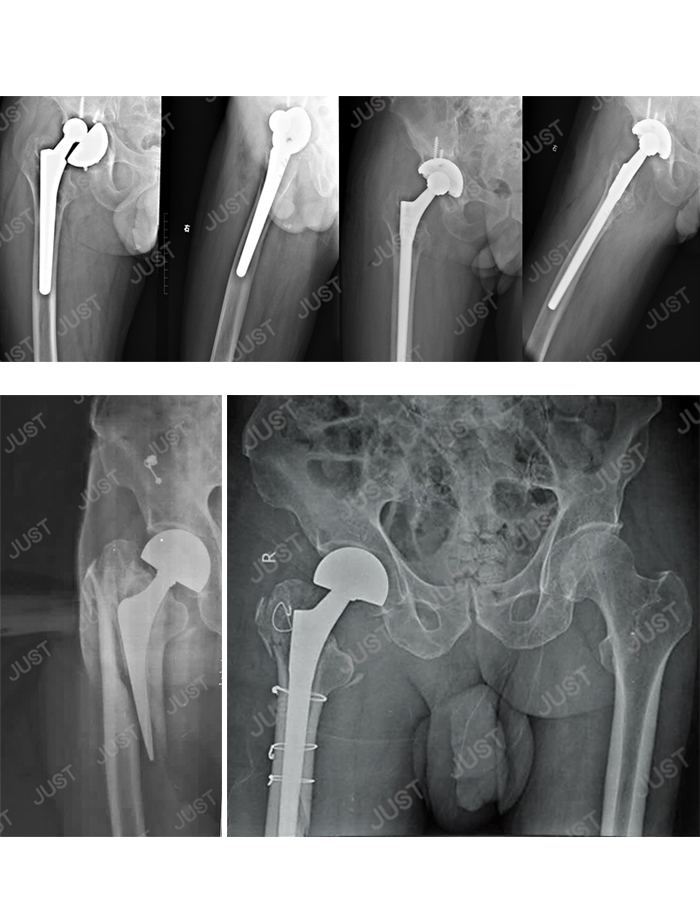Conjunto de imágenes de rayos X SOLO: articulación de la cadera