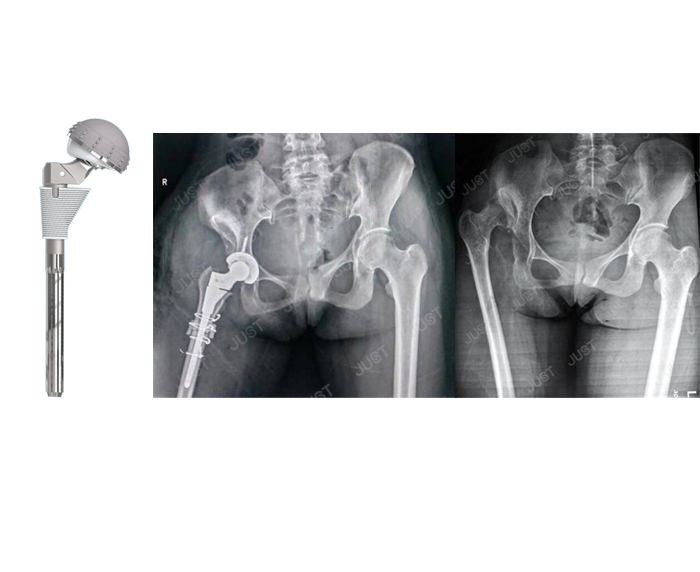 Conjunto de imágenes de rayos X SOLO: articulación de la cadera