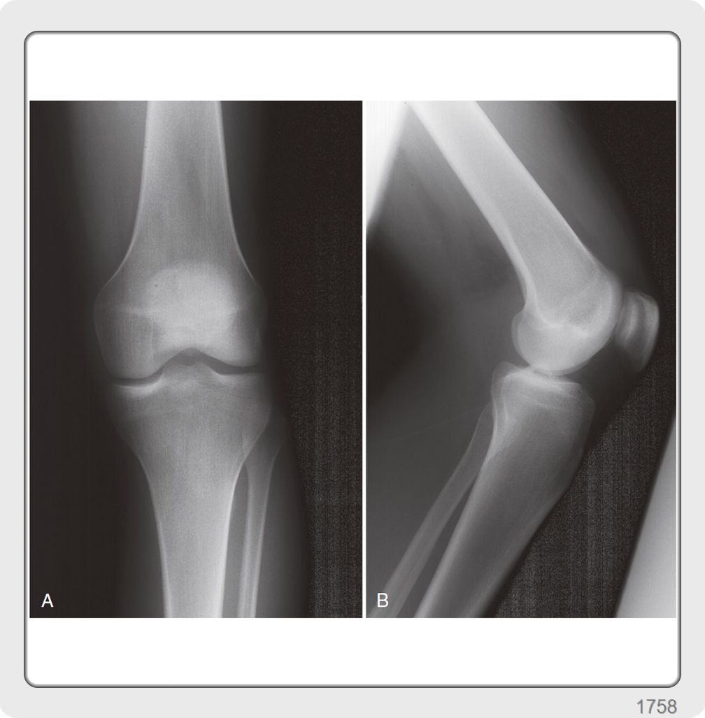 Bony architecture of knee joint- tibia, patella