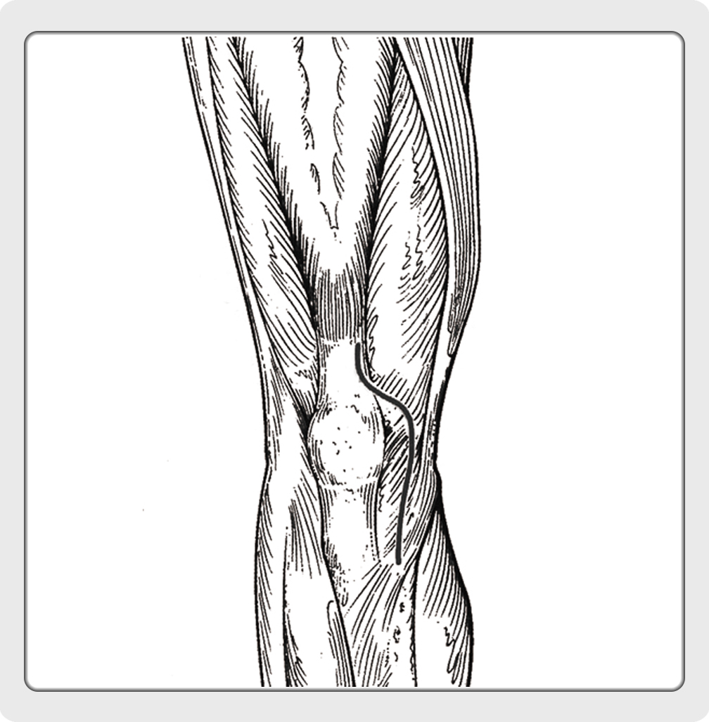 Primary Total Knee Arthroplasty Surgical Technique 